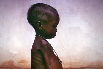 Una niña sufre de kwashiorkor, una enfermedad causada por la desnutrición.