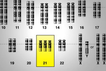 Esquema de una mutación genética de la trisomía 21.